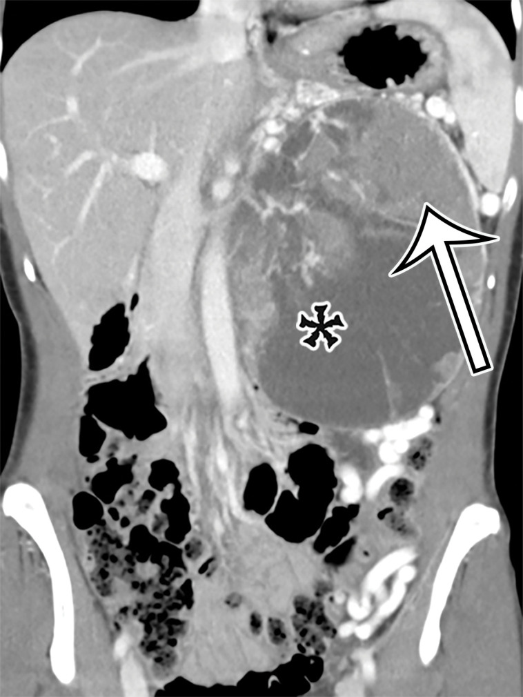 Pancreatic solid-pseudopapillary neoplasm (SPN) in a 42-year-old woman. (a) Coronal contrast-enhanced CT image shows a large solid (arrow) and cystic (*) tumor centered in the left upper quadrant, but of unclear origin. (b) Photograph of the cut resected specimen shows that the tumor arises from the pancreas (P). The tan-pink viable tissue (arrow) corresponds to the area of solid components seen at CT, and the hemorrhagic (arrowhead) and cystic necrotic (*) components correspond to similar areas seen at CT.