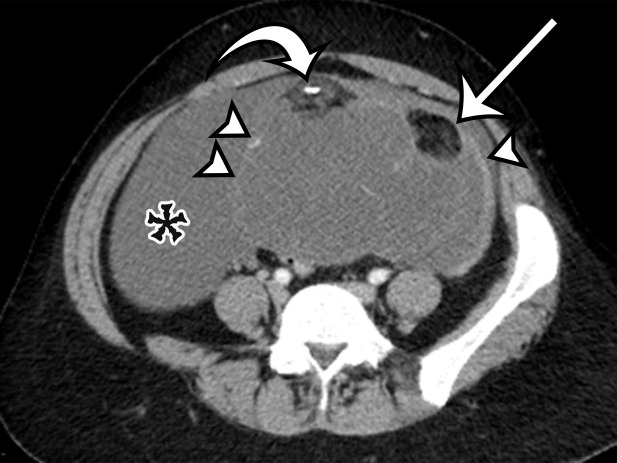 Spectrum of adnexal-origin cystic masses. (a) Axial T2-weighted image in a 67-year-old woman with right lower quadrant pain shows homogeneous hyperintense signal in a well-circumscribed unilocular thin-walled cyst (*), which was found to arise from the right ovary. Histologic analysis showed benign epithelium, consistent with serous cystadenoma. (b) Axial contrast-enhanced image in a 62-year-old woman with increasing abdominal girth shows a well-circumscribed multiloculated cyst with multiple thin septa (arrowhead) but no mural nodules. Surgically, the cyst was found to arise from the right ovary. Histologic analysis showed a single layer of mucinous epithelium, consistent with MCN. (c) Axial contrast-enhanced CT image in a 32-year-old woman with increasing abdominal pain shows a large multiloculated cystic mass (arrowheads) in the midline pelvis, which contains calcification (curved arrow) and fat (straight arrow) and is surrounded by ascites (*). The mass was found to arise from the left ovary. Histologically, it was shown to be a mature cystic teratoma.