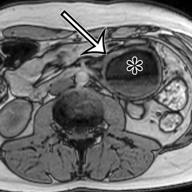 Chylolymphatic cyst in a 24-year-old woman with acute onset of abdominal pain, with gross pathologic correlation. (a) Axial contrast-enhanced CT image shows a well-circumscribed thin-walled cyst in the midabdomen (arrow) with a fat-fluid level. * = fat-containing chylous component. (b) Axial T1-weighted MR image shows that the fat-containing chylous component (*) of the cyst (arrow) is hyperintense. (c) Axial out-of-phase T1-weighted image shows diffuse loss of signal intensity in the fat-containing chylous component (*) of the cyst (arrow). (d) Photograph of the opened specimen shows a thin-walled unilocular cyst (arrow) with a small amount of residual thick milky yellow fluid (*).