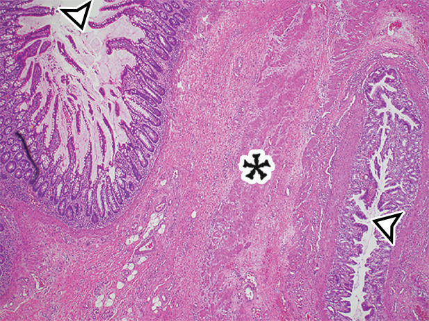 EDC with pathologic correlation. (a) Transabdominal US image at the level of the inferior margin of the liver (L) shows the gut signature sign (also known as the double-wall or five-layer sign) of the EDC wall. The multilayered alternating echogenic appearance resembles normal bowel, with similar innermost hyperechoic mucosa, hypoechoic muscularis mucosa, hyperechoic submucosa, hypoechoic muscularis propia, and outermost hyperechoic serosa (bracket) of the duplicated bowel wall of the EDC (*). This cyst served as the lead point for an intussusception (shown in Fig E5) and was resected. (b) Photograph of a cut gross specimen shows the common wall (arrowheads) of the EDC and subjacent bowel loop. Lumen = small-bowel lumen. (c) Low-power photomicrograph (H-E stain) of an EDC shows the shared wall (*) between the small-bowel loop and EDC. Arrowheads = mucosae.