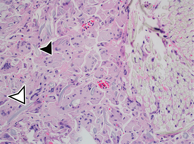 Foreign body in a 20-year-old man with an enlarging abdominal mass and a history of gunshot wound to the abdomen 7 years earlier. (a) Axial contrast-enhanced CT image shows a large complex thick-walled cystic structure (arrow) in the anterior abdomen. There are thin nonenhancing undulating internal septa (arrowhead) but no radiopaque marker. (b) Photograph of the gross resected specimen shows that the linear septa correlate with the folds of a surgical towel (arrowhead), encapsulated by a thick fibrous wall (arrow). (c) High-power photomicrograph (H-E stain) shows giant cells with invaginated (black arrowhead) and encased (white arrowhead) synthetic fibers.