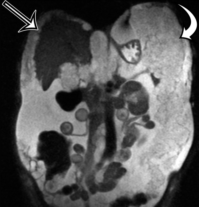 PMP in a 57-year-old man. (a) Sagittal US image shows masslike expansion of the omentum with echogenic septa (arrow) surrounded by hypoechoic gelatinous fluid. The subjacent bowel loops are displaced centrally. (b) Axial contrast-enhanced CT image shows low-attenuation fluid surrounding the liver and displacing the stomach, with scalloping of the hepatic surface (arrow), which represents extrinsic pressure from the mucinous implants. (c) Coronal T2-weighted image shows scalloping of the intraperitoneal visceral surfaces (straight arrow) and heterogeneous signal intensity of the fluid (curved arrow), which allow differentiation of PMP from simple ascites.