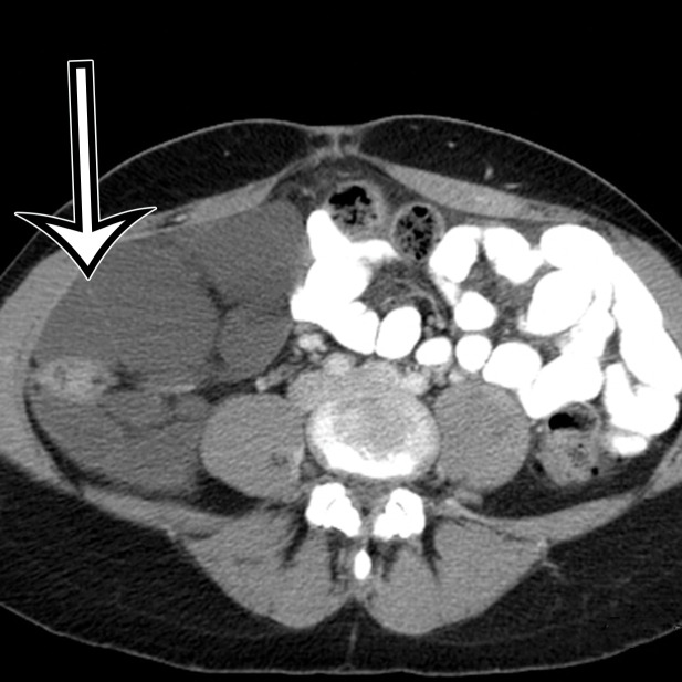 Cystic lymphangioma in a 33-year-old woman with a 2-week history of right lower quadrant pain, with pathologic correlation. (a, b) Transverse US (a) and axial contrast-enhanced CT (b) images show a thin-walled multiloculated cyst containing thin septa (arrow) that insinuates around the colon.(c) Photograph of the cut gross specimen shows the multilocular nature of the lymphangioma, with cystic spaces of varying size (*) and thin septa (arrow). (d) Photomicrograph of a cystic lymphangioma shows multiple thin-walled cystic spaces lined with endothelial cells and containing lymph (*). (MRI features are shown in Figure E1.)