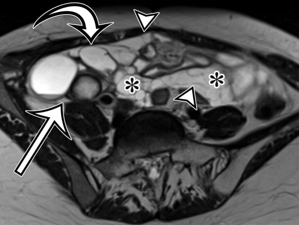 MCPM in a 34-year-old woman. (a–d) Axial (a), coronal (b), and sagittal (c) T2-weighted images and axial T1-weighted image (d) show a multiloculated cystic mass (straight arrow) with thin septa (arrowheads) in the pelvis. The mass arises from the pelvic peritoneum, infiltrates around bowel loops, and surrounds the right ovary. Most loculi contain simple T2-hyperintense fluid (* in a–c), which is hypointense on the T1-weighted image (* in d); however, one loculus (curved arrow in a and d) shows increased signal intensity on both T1-weighted and T2-weighted images, consistent with internal blood contents. Incidentally noted are T1-hyperintense hemorrhagic cysts in the right ovary (straight arrow in d); the lateral cyst contains layering T1-hyperintense blood products, and the superomedial cyst has a T2-hypointense rim (straight arrow in a). (e, f) Photographs of a whole (e) and cut (f) gross specimen show the multicystic nature of a peritoneal mesothelioma, with a grapelike appearance of the whole specimen (arrow in e). The cut specimen shows the mass to be comprised of innumerable cystic spaces of varying size separated by a thin fibrovascular stroma (arrowhead in f), which matches the appearance at MRI. (g, h) High-power photomicrographs with H-E stain (g) and calretinin immunohistochemical stain (h) show multiple small cystic spaces (*) lined by cuboidal mesothelium (arrow), which stains positive for calretinin, a mesothelial marker. (Original magnification, ×100.)