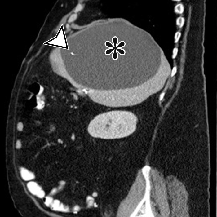 CSF pseudocyst, also known as abdominal peritoneal pseudocyst (APC), in a 49-year-old man with a long-term ventriculoperitoneal (VP) shunt. Axial (a) and sagittal (b) contrast-enhanced CT images show a well-circumscribed thin-walled subcapsular unilocular cyst (*) occupying nearly the entire right lobe of the liver, intimately associated with the distal tip of a VP shunt (arrowhead).