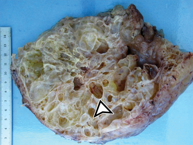 MCPM in a 34-year-old woman. (a–d) Axial (a), coronal (b), and sagittal (c) T2-weighted images and axial T1-weighted image (d) show a multiloculated cystic mass (straight arrow) with thin septa (arrowheads) in the pelvis. The mass arises from the pelvic peritoneum, infiltrates around bowel loops, and surrounds the right ovary. Most loculi contain simple T2-hyperintense fluid (* in a–c), which is hypointense on the T1-weighted image (* in d); however, one loculus (curved arrow in a and d) shows increased signal intensity on both T1-weighted and T2-weighted images, consistent with internal blood contents. Incidentally noted are T1-hyperintense hemorrhagic cysts in the right ovary (straight arrow in d); the lateral cyst contains layering T1-hyperintense blood products, and the superomedial cyst has a T2-hypointense rim (straight arrow in a). (e, f) Photographs of a whole (e) and cut (f) gross specimen show the multicystic nature of a peritoneal mesothelioma, with a grapelike appearance of the whole specimen (arrow in e). The cut specimen shows the mass to be comprised of innumerable cystic spaces of varying size separated by a thin fibrovascular stroma (arrowhead in f), which matches the appearance at MRI. (g, h) High-power photomicrographs with H-E stain (g) and calretinin immunohistochemical stain (h) show multiple small cystic spaces (*) lined by cuboidal mesothelium (arrow), which stains positive for calretinin, a mesothelial marker. (Original magnification, ×100.)