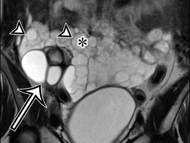 MCPM in a 34-year-old woman. (a–d) Axial (a), coronal (b), and sagittal (c) T2-weighted images and axial T1-weighted image (d) show a multiloculated cystic mass (straight arrow) with thin septa (arrowheads) in the pelvis. The mass arises from the pelvic peritoneum, infiltrates around bowel loops, and surrounds the right ovary. Most loculi contain simple T2-hyperintense fluid (* in a–c), which is hypointense on the T1-weighted image (* in d); however, one loculus (curved arrow in a and d) shows increased signal intensity on both T1-weighted and T2-weighted images, consistent with internal blood contents. Incidentally noted are T1-hyperintense hemorrhagic cysts in the right ovary (straight arrow in d); the lateral cyst contains layering T1-hyperintense blood products, and the superomedial cyst has a T2-hypointense rim (straight arrow in a). (e, f) Photographs of a whole (e) and cut (f) gross specimen show the multicystic nature of a peritoneal mesothelioma, with a grapelike appearance of the whole specimen (arrow in e). The cut specimen shows the mass to be comprised of innumerable cystic spaces of varying size separated by a thin fibrovascular stroma (arrowhead in f), which matches the appearance at MRI. (g, h) High-power photomicrographs with H-E stain (g) and calretinin immunohistochemical stain (h) show multiple small cystic spaces (*) lined by cuboidal mesothelium (arrow), which stains positive for calretinin, a mesothelial marker. (Original magnification, ×100.)