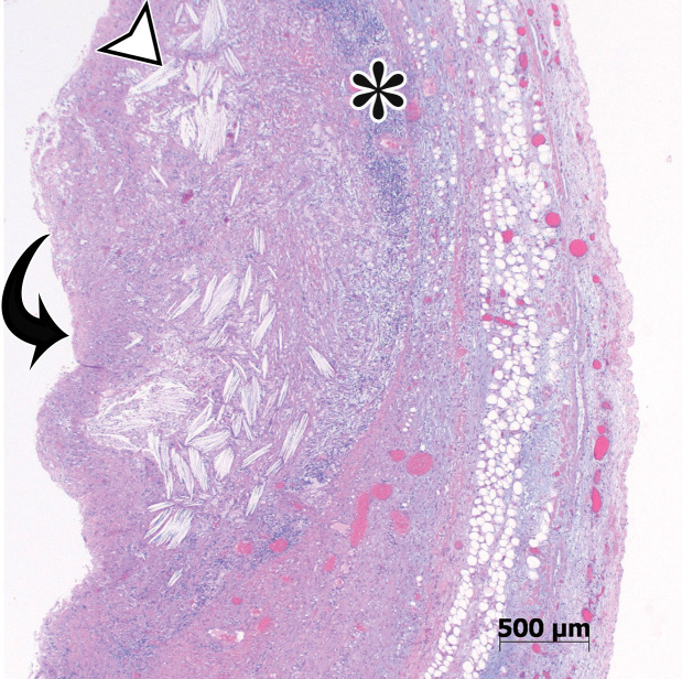 Nonpancreatic pseudocyst in a 40-year-old woman with sudden onset of severe right upper abdominal pain, with pathologic correlation.(a, b) Sagittal US (a) and axial contrast-enhanced CT (b) images show a well-circumscribed complex cystic lesion centered in the left mesentery (arrow). There is a fluid-fluid level (*), with chylous fluid layering nondependently. (c) Photograph of the resected specimen shows thick yellow fluid oozing from the incised surface. (d) Low-power photomicrograph (H-E stain) shows the thick fibrous cyst wall containing cholesterol crystals (arrowhead) and lymphocytes (*), with no epithelium (arrow). Pseudocysts occur when a fibrous wall forms around fluid or a foreign body and lack a true lining.