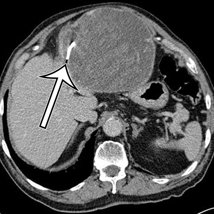 Foreign body in a 78-year-old man with epigastric pain. Axial contrast-enhanced CT image shows a thick-walled complex cystic structure in the epigastric anterior abdomen that contains a high-attenuation radiopaque marker (arrow), indicative of a retained surgical sponge.