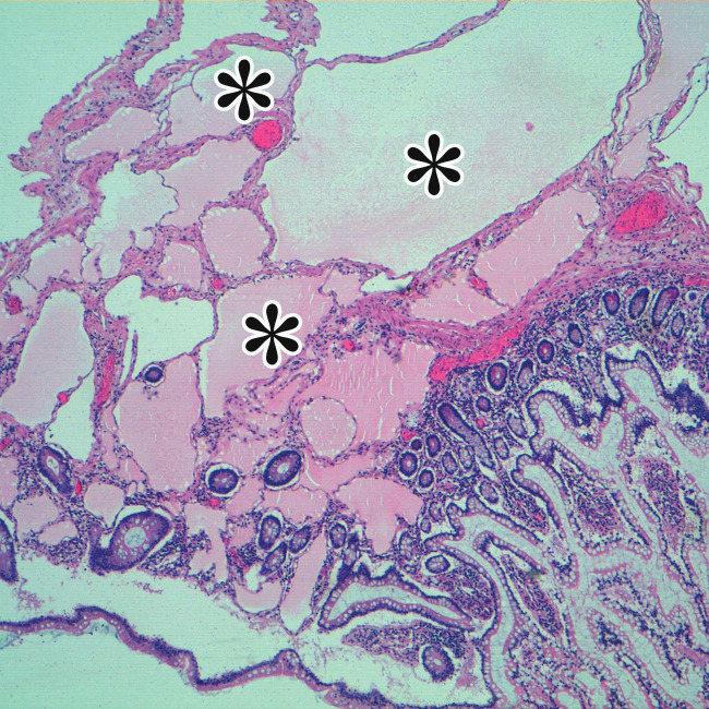 Cystic lymphangioma in a 33-year-old woman with a 2-week history of right lower quadrant pain, with pathologic correlation. (a, b) Transverse US (a) and axial contrast-enhanced CT (b) images show a thin-walled multiloculated cyst containing thin septa (arrow) that insinuates around the colon.(c) Photograph of the cut gross specimen shows the multilocular nature of the lymphangioma, with cystic spaces of varying size (*) and thin septa (arrow). (d) Photomicrograph of a cystic lymphangioma shows multiple thin-walled cystic spaces lined with endothelial cells and containing lymph (*). (MRI features are shown in Figure E1.)