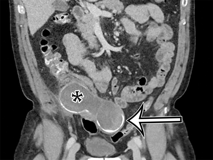 Appendiceal mucinous neoplasm in a 64-year-old man with right lower quadrant pain. (a) Coronal contrast-enhanced CT image shows marked distention of the appendix, with heterogeneous internal contents (*) and curvilinear calcification of the appendiceal wall (arrow). (b) Photograph of the intact resected specimen shows a mucin-distended rubbery appendix (*). Histopathologic analysis of the appendiceal wall demonstrated tall columnar mucinous bland epithelium, seen with low-grade appendiceal mucinous neoplasms (LAMNs) (Fig E6).