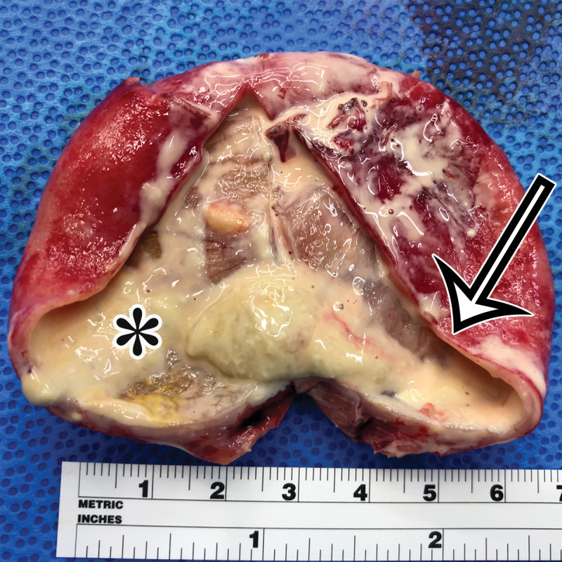 Chylolymphatic cyst in a 24-year-old woman with acute onset of abdominal pain, with gross pathologic correlation. (a) Axial contrast-enhanced CT image shows a well-circumscribed thin-walled cyst in the midabdomen (arrow) with a fat-fluid level. * = fat-containing chylous component. (b) Axial T1-weighted MR image shows that the fat-containing chylous component (*) of the cyst (arrow) is hyperintense. (c) Axial out-of-phase T1-weighted image shows diffuse loss of signal intensity in the fat-containing chylous component (*) of the cyst (arrow). (d) Photograph of the opened specimen shows a thin-walled unilocular cyst (arrow) with a small amount of residual thick milky yellow fluid (*).