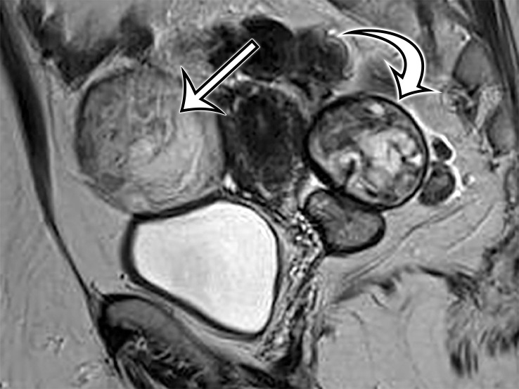 Peritoneal hydatidosis in an asymp­tomatic 49-year-old woman. (a, b) Axial CT images through the lower abdomen (a) and pelvis (b) show multiple well-circumscribed cystic lesions. The cyst along the posterior margin of the liver (arrow in a) has smooth mural calcifications. The cysts in the left upper quadrant (arrowhead in a) and pelvis (arrowhead in b) have a multiloculated appearance, with internal cysts of differing attenuation. (c) Sagittal T2-weighted image better shows the internal cyst architecture, including the floating inner membrane (straight arrow); the posterior pelvic cyst wall (curved arrow) is markedly T2 hypointense owing to the abundant collagen content. (d) Axial contrast-enhanced T1-weighted image shows enhancement of the thin walls and septa (arrow) but no internal nodularity or enhancement. Intraoperatively, there were innumerable hydatid cysts studding the peritoneum in addition to the multiple abdominal and pelvic cysts, consistent with disseminated hydatidosis, presumed secondary to a ruptured hepatic hydatid cyst.