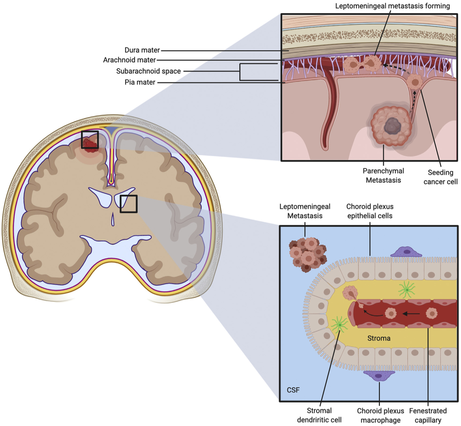 leptomeningeal-carcinomatosis-molecular-landscape-current-management