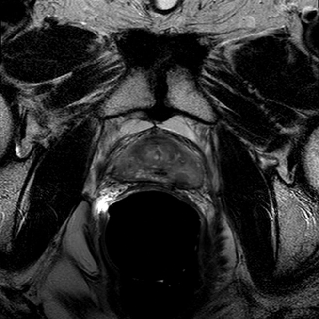 Images show 2-(3-(5)-ureido)-pentanedioic acid (18F-DCFPyL) PET/CT–positive, multiparametric MRI–positive, and biopsy-positive lesion in a 62-year-old man (prostate-specific antigen level of 1.48 ng/mL) with history of prostate cancer, treated with external beam radiation therapy, now with biochemically recurrent prostate cancer. Histologically proven lesion in left midbase depicted with 18F-DCFPyL (arrows) ([a] PET and [b] PET/CT) and multiparametric MRI ([c] T2-weighted MRI, [d] b = 2000 sec/mm2 diffusion-weighted MRI, [e] apparent diffusion coefficient map, [f] dynamic contrast material–enhanced MRI) show grade 6 (high likelihood for recurrent prostate cancer).