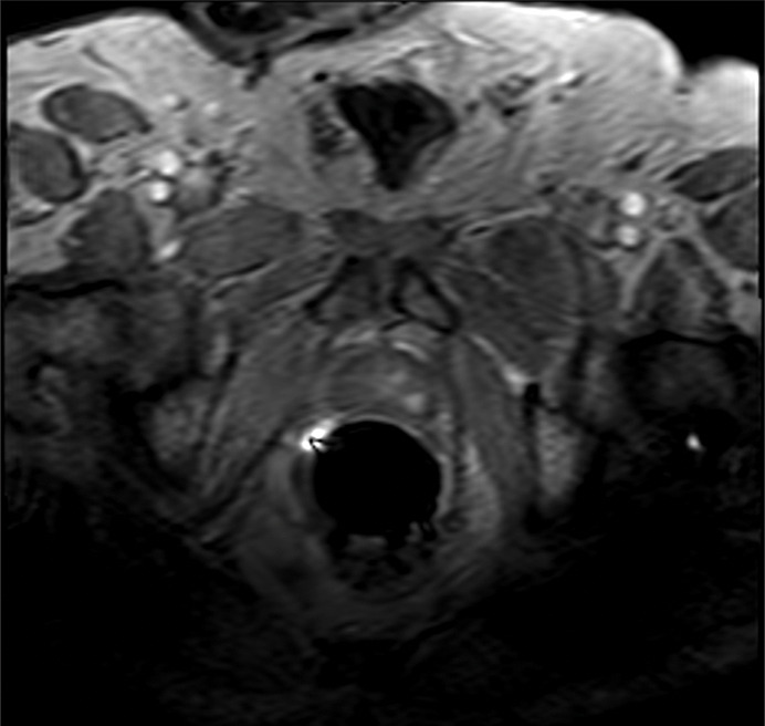 Images show 2-(3-(5)-ureido)-pentanedioic acid (18F-DCFPyL) PET/CT–positive, multiparametric MRI–positive, and biopsy-positive lesion in a 62-year-old man (prostate-specific antigen level of 1.48 ng/mL) with history of prostate cancer, treated with external beam radiation therapy, now with biochemically recurrent prostate cancer. Histologically proven lesion in left midbase depicted with 18F-DCFPyL (arrows) ([a] PET and [b] PET/CT) and multiparametric MRI ([c] T2-weighted MRI, [d] b = 2000 sec/mm2 diffusion-weighted MRI, [e] apparent diffusion coefficient map, [f] dynamic contrast material–enhanced MRI) show grade 6 (high likelihood for recurrent prostate cancer).