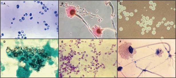 Photomicrographs of the most common fungal pathogens causing invasive diseases in humans. A: Candida albicans in its yeast-phase; B: filamentous conidiophores of Aspergillus fumigatus; C: encapsulated yeasts of Cryptococcus neoformans; D: Pneumocystis jirovecii cysts; E: Histoplasma capsulatum in its yeast phase; F: reproductive sporangia of Rhizopus oryzae. Images are not copyrighted and were obtained from the public domain of the Public Health Image Library (PHIL) from the Centers for Disease Control and Prevention (CDC) (phil.cdc.gov).
73

