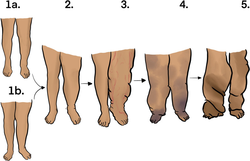 Outcomes of Lymphovenous Anastomosis for Lower Extremity Lymphedema: A ...