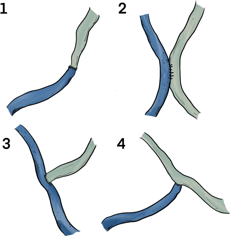 Outcomes of Lymphovenous Anastomosis for Lower Extremity Lymphedema: A ...