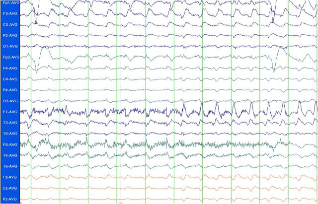 FIGURE 2. EEG showing SE. Standard 10-20 system EEG in average referential montage display, demonstrating rhythmic sharps and δ frequency ictal activity maximal in the left frontal region. Patient was a 2-year-old girl with cardiopulmonary arrest secondary to pulmonary hemorrhage. She became less responsive several days after her arrest. An MRI demonstrated multifocal cortical signal abnormalities consistent with cerebral edema. This EEG was obtained, and a diagnosis of NCSE was made. She was eventually stabilized but on follow-up had significant neurologic impairment.