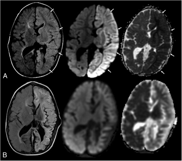 FIGURE 3. A 2-year-old boy with new-onset seizures and sepsis. History of previous white matter injury of prematurity and intraventricular hemorrhage. Shunt dependent hydrocephalus. L-R: Axial fluid attenuated inversion recovery image, axial diffusion-weighted image, and apparent diffusion coefficient map. A, At acute clinical presentation. Note the extensive edema and gyral swelling throughout the left hemisphere on the fluid attenuated inversion recovery sequence (arrows). Increased signal is also noted involving the left thalami and basal ganglia. Trace diffusion-weighted image map demonstrates extensive increased signal throughout the left hemisphere. Apparent diffusion coefficient map demonstrates left hemispheric diffusion restriction involving both the cortex and white matter. Follow-up imaging (1 month later) demonstrates diffuse left hemispheric volume loss and evolution of diffusion changes. Clinically, he had acute flaccid right hemiplegia. At 6-month follow-up, he was improved but continued to have persistent spastic right hemiparesis. Language developmental milestones were normal.