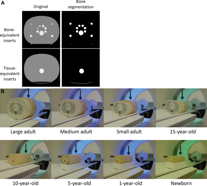 (A) Cross-sectional CT images of the large adult anthropomorphic abdomen phantom show cylindrical cavities filled with bone-equivalent inserts (top row) and cylindrical cavities filled with tissue-equivalent inserts (bottom row). The large white circle is the bone-equivalent spine of the phantom. The left-side images are the original images; the right-side images are those after bone segmentation. (B) Phantom configuration for scans of the chest. The ionization chamber was placed longitudinally at the center of scan range in the chest phantom (arrows). Similarly sized phantoms were placed next to each chest phantom to provide sufficient scattering media to accommodate a scan length appropriate for a typical patient in each size and age category.