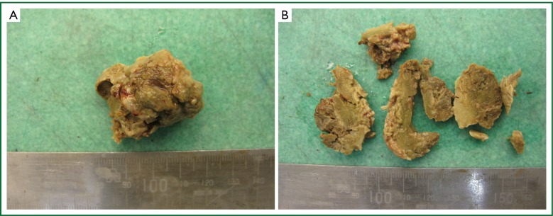 Aspergilloma and the surgeon - PMC