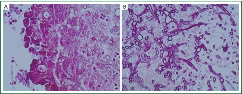 Aspergilloma and the surgeon - PMC