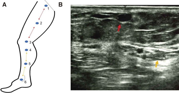 Fig. 1 (A) Scheme and the definition of the 6 points. Point 1: The sapheno-femoral junction was depicted. Point 2: The midpoint between points 1 and 3. Point 3: The knee joint level. Point 4: The saphenous nerve and the GSV could be seen on the ultrasonography monitor simultaneously below the knee (B). Point 5 was the midpoint between points 4 and 6. Point 6: The level of the medial malleolus. Straight dotted line: inguinal ligament, curved dotted line: medial malleolus. The distances between 1 and 2, 2 and 3 are equal (red arrowed line). The distances between 4 and 5, 5 and 6 are equal (yellow arrowed line). (B) The GSV and the saphenous nerve at the point 4. Red arrow: GSV; yellow arrow: saphenous nerve. These 2 components are depicted simultaneously. In this case, the distance between them is 14 mm. GSV: great saphenous vein