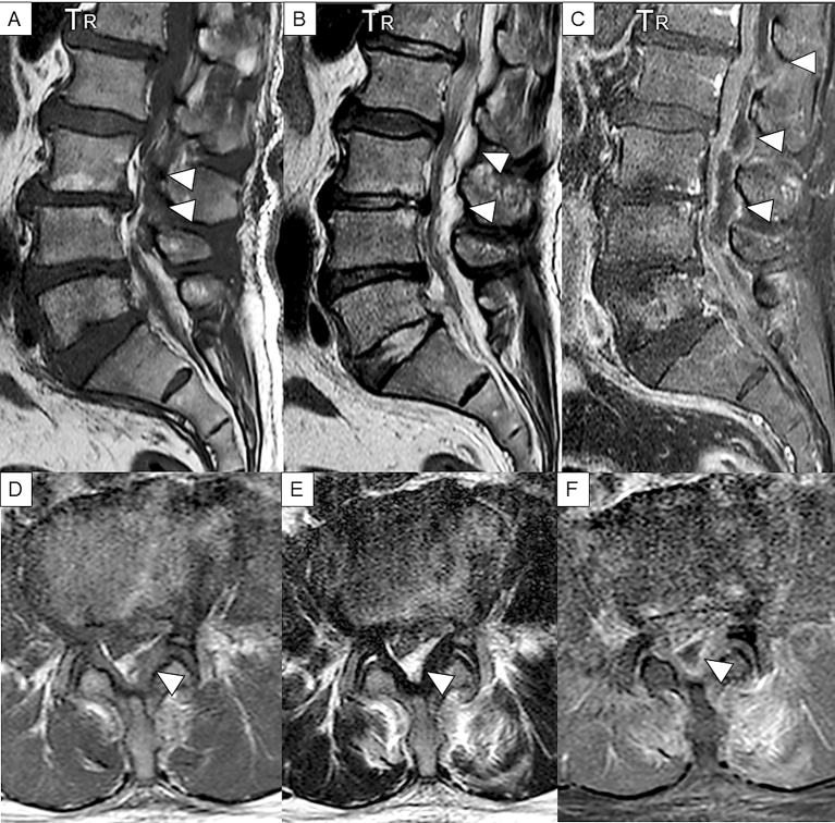 Spinal Epidural Abscess: A Review Highlighting Early Diagnosis and ...