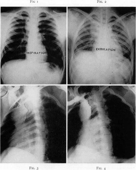 Fig. 1., Fig. 2., Figs. 3 and 4.