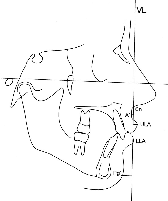 Long-Term Dentoskeletal Effects and Facial Profile Changes Induced by ...