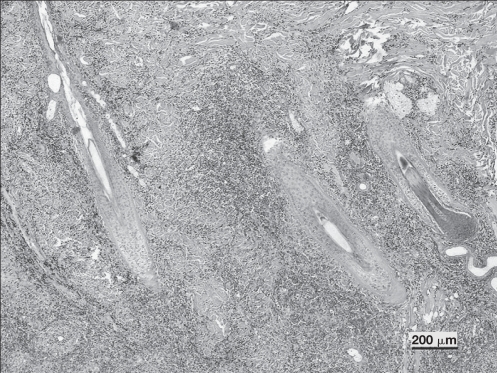 Cutaneous sterile pyogranuloma/granuloma syndrome in a dog - PMC