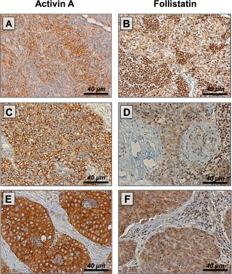 Follistatin Impacts Tumor Angiogenesis And Outcome In Thymic Epithelial 