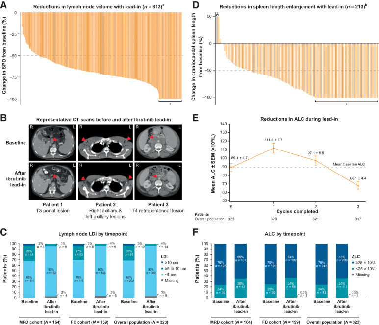 Figure 1. Single-agent ibrutinib lead-in impact on tumor debulking. A, Waterfall plot of percent change in the sum of the products of perpendicular diameters of target lymph nodes (SPD) in individual patients after ibrutinib lead-in,a (B) representative CT scans of target lymph nodes at baseline and after ibrutinib lead-in, (C) lymph node maximal LDi of target lymph nodes at baseline and after ibrutinib lead-in, (D) waterfall plot of percent change in spleen length enlargement in individual patients after ibrutinib lead-in,b (E) mean ALC by cycle during ibrutinib lead-in, and (F) ALC by timepoint at baseline and after ibrutinib lead-in. aIn patients with measurable target lesions (LDi >1.5 cm) at baseline and measured after ibrutinib lead-in (n = 313). bIn patients with spleen length enlarged >13 cm at baseline and measured after ibrutinib lead-in (n = 213). cLDi resolved to ≤1.5 cm or spleen length resolved to ≤13 cm. dSpleen length enlargement was increased by 400% (from 0.3 to 1.5 cm) in one patient, by 275% (from 0.4 to 1.5 cm) in one patient, and by 85% (from 2.5 to 3.9 cm) in one patient. ALC, absolute lymphocyte count; CT, computed tomography; FD, fixed duration; LDi, maximal lymph node diameter of target lesions; MRD, minimal residual disease; SEM, standard error of the mean.