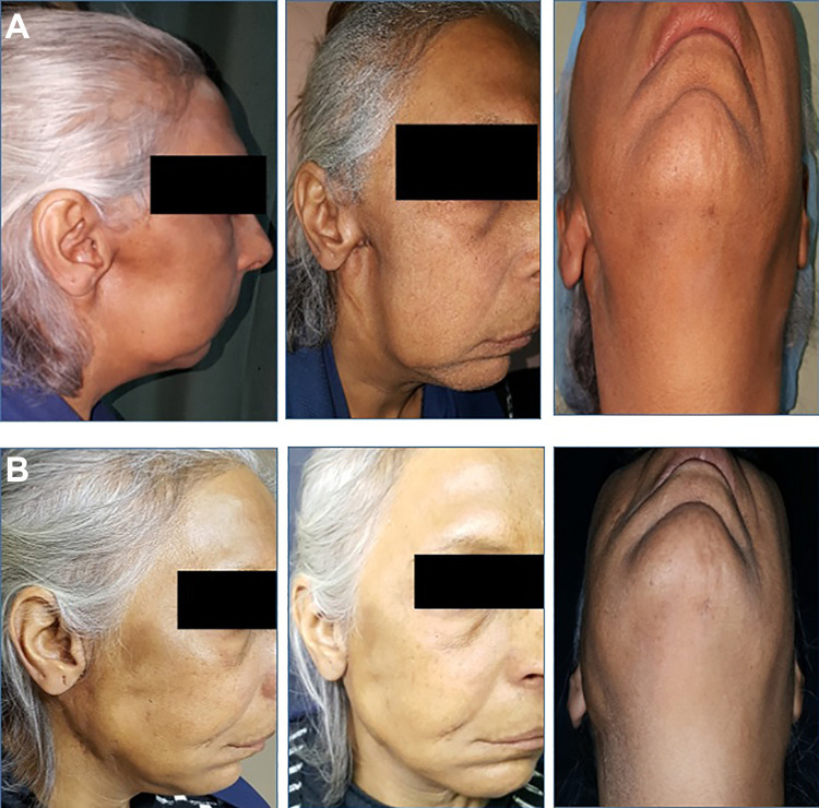 Free Dermal Fat Graft for Reconstruction of Soft Tissue Defects in the ...