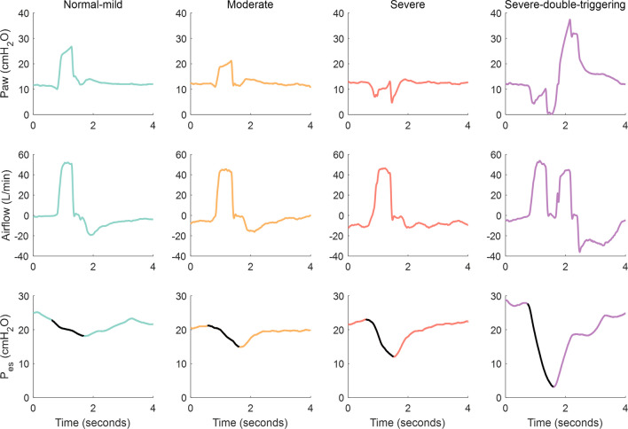 Flow Starvation During Square-flow Assisted Ventilation Detected By 