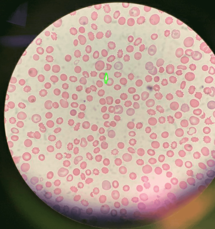 tacrolimus-induced-thrombotic-microangiopathy-after-orthotopic-heart