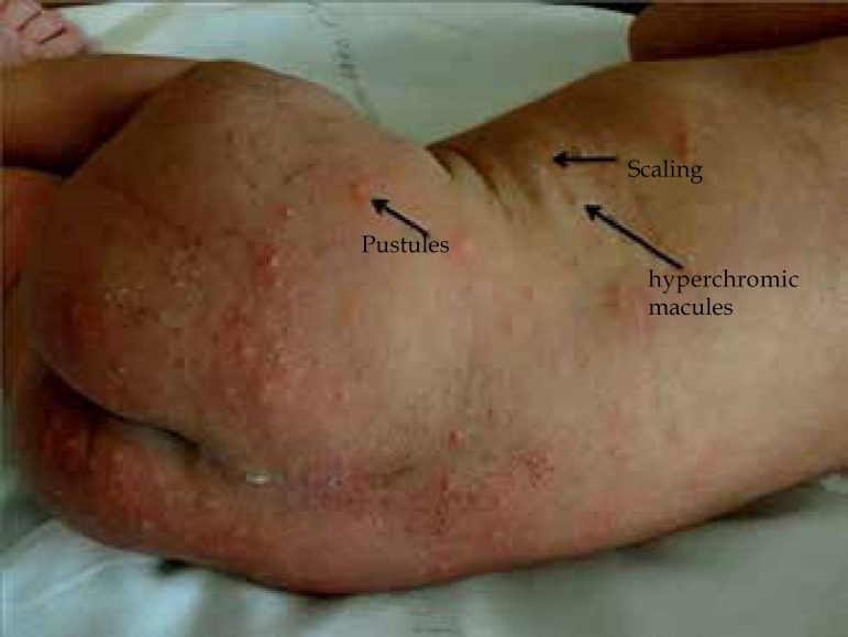 Benign skin disease with pustules in the newborn - PMC