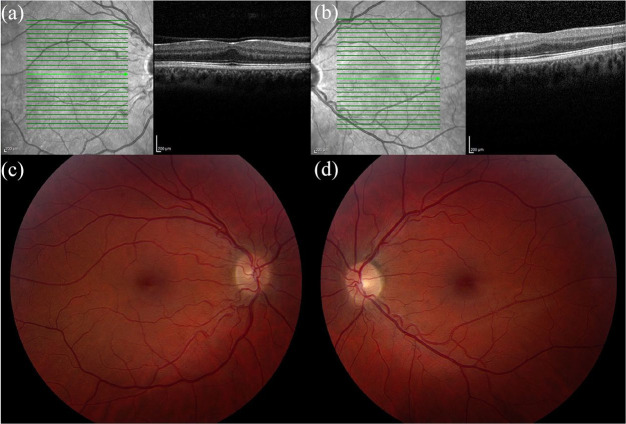 Clinical spectrum of blunted foveal contour - PMC