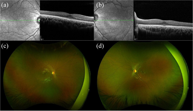 Clinical spectrum of blunted foveal contour - PMC