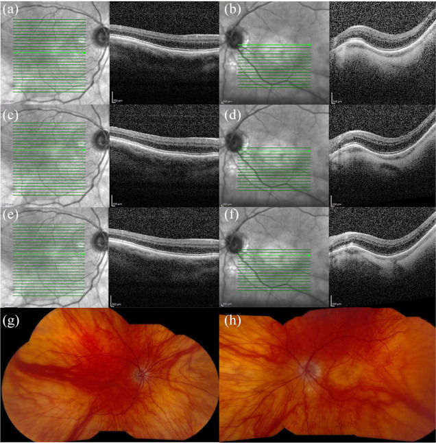 Clinical spectrum of blunted foveal contour - PMC