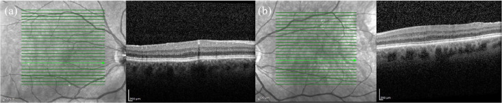 Clinical spectrum of blunted foveal contour - PMC