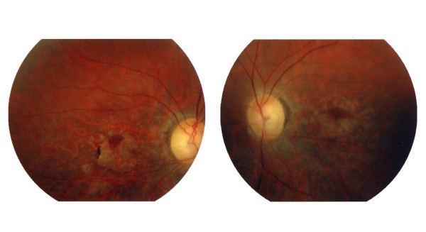 A novel locus (CORD12) for autosomal dominant cone-rod dystrophy on ...