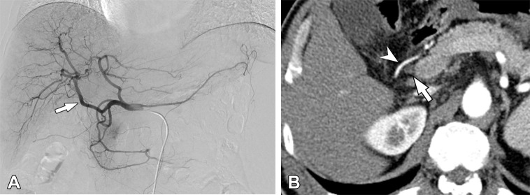 Aberrant right hepatic artery (aRHA) originating from the gastroduodenal artery (GDA) in a 59-year-old man. (A) The digital subtraction angiographic image obtained at the common hepatic artery shows the aRHA (arrow) originating from the GDA. (B) On an axial arterial phase CT image, the aRHA (arrowhead) is coursed anteriorly to the common bile duct (arrow).