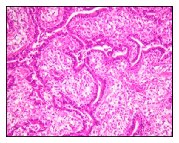 Pulmonary Blastoma: A Rare Primary Lung Malignancy - PMC