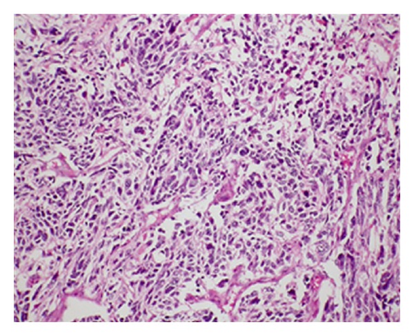 Pulmonary Blastoma: A Rare Primary Lung Malignancy - PMC