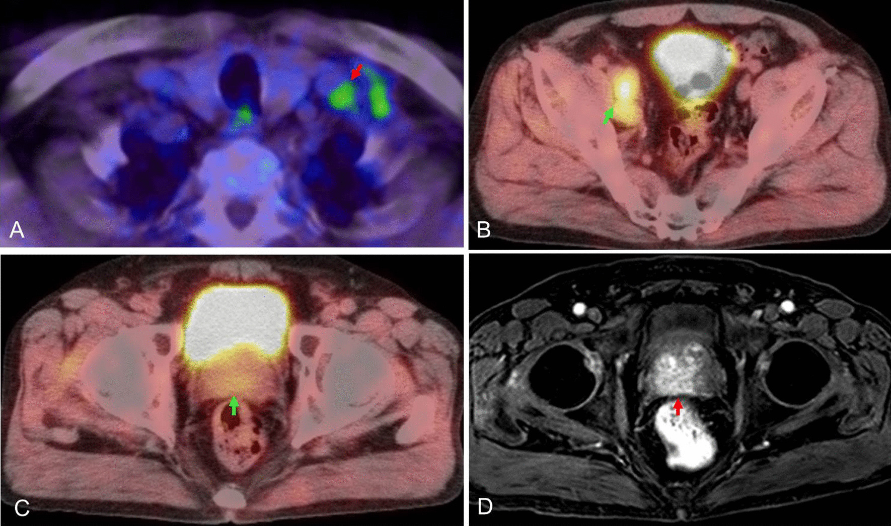 Left supraclavicular (Virchow’s) node metastasis detected before ...