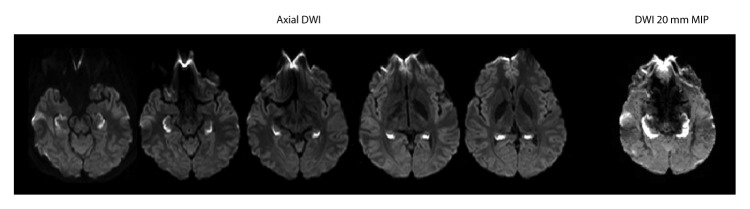 The figure above is a scan showing diffusion-weighted imaging findings at the initial brain magnetic resonance imaging of a patient with unusual amnestic syndrome in Massachusetts during 2012.