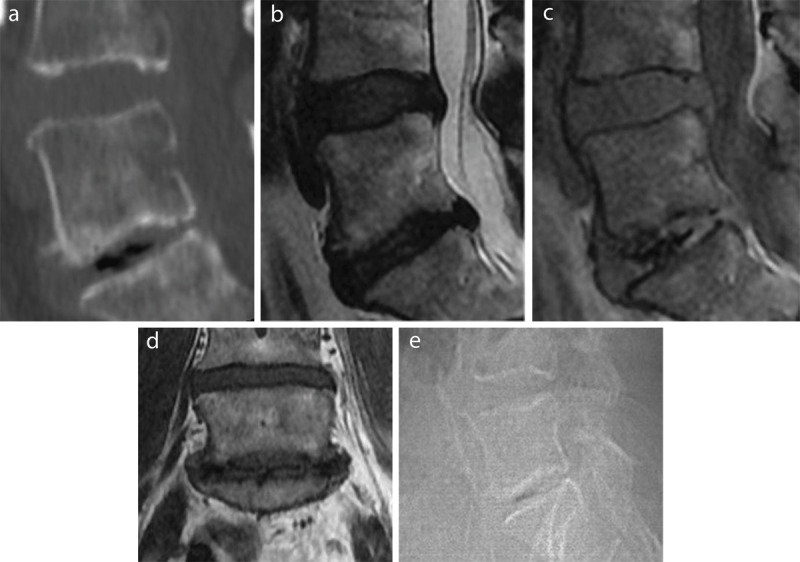 Vacuum phenomenon as intradiscal gas, represented by linear dark signal centrally in the disc, in the lower (L5-S1) of the two visualized discs (L4-L5 and L5-S1), most conspicuous on a sagittal reconstruction of a CT lumbar spine in bone window; least conspicuous and almost indiscernible on a sagittal T2-weighted image, almost equally conspicuous on a GE-weighted image compared to the CT image, rather discrete, as a fine dark line on a coronal T1-weighted image, and discrete, as a blurry linear dark signal, on the lateral scout image from the CT exam